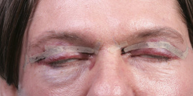 eyelid surgery scars