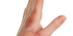 2nd degree burn wound care